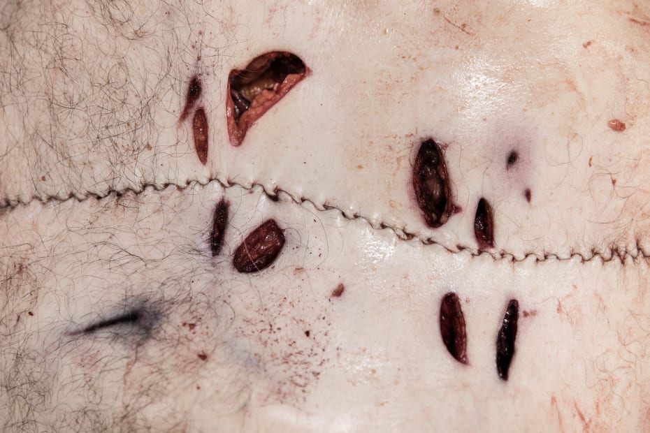 Finally, Erling Laursen threads a leatherwork needle and sews the homicide victim together again with cotton thread, so he is ready to be viewed by his next-of-kin.