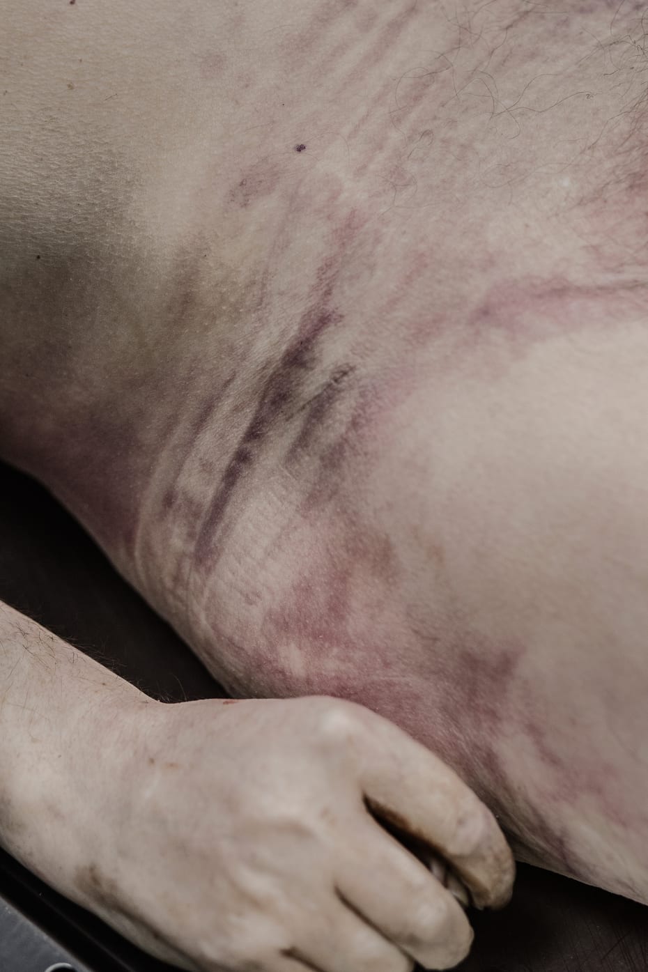 It has been three days since the homicide was committed, and on the dead man's body faint purple post-mortem lividity has formed, for example on the hip.