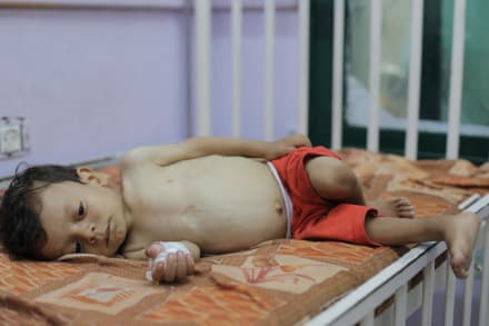 På grund af Israels restriktioner på mad og medicin til Gazastriben behandles børn, der lider af sult under ekstremt begrænsede forhold. Her ses et barn på Al-Aqsa Martyrs Hospital i Deir al-Balah i Gaza den 20. august 2025.